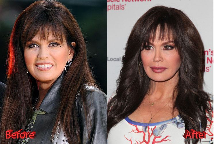 Marie Osmond Plastic Surgery Marie’s Youthful Looks
