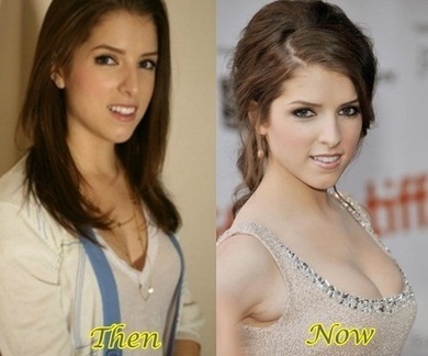 anna kendrick before and after plastic surgery