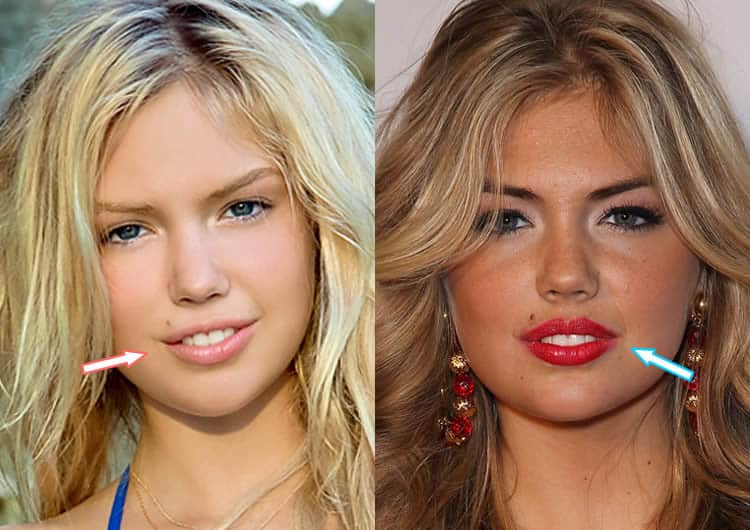 kate upton plastic surgery